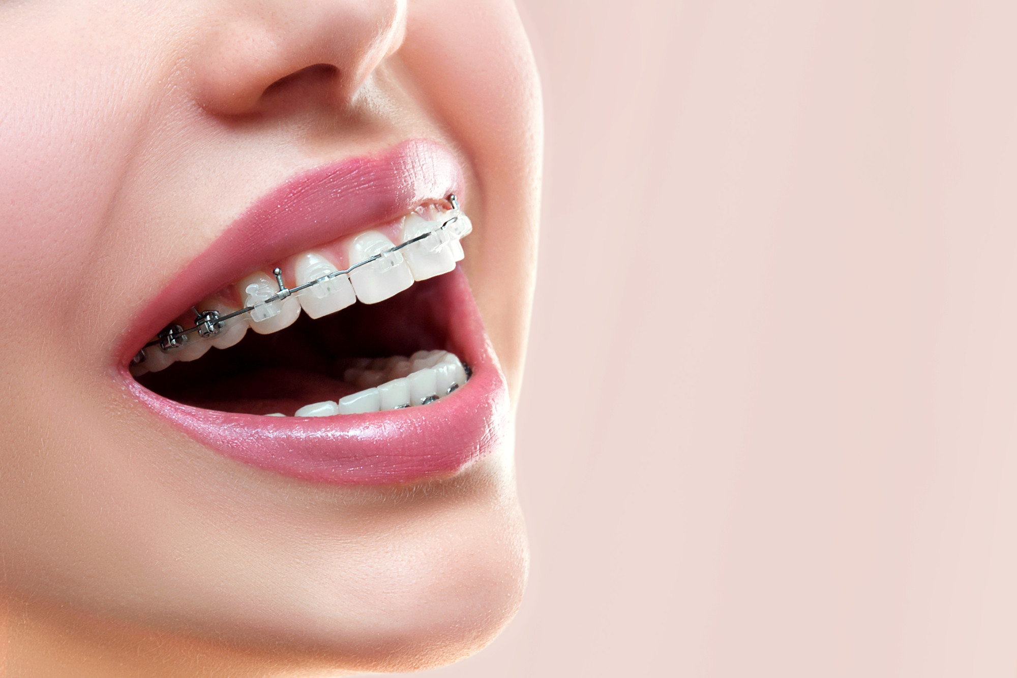 Ceramic braces, also known as clear braces, are an alternative teeth straightening option to metal braces. Learn the pros and cons of ceramic braces here.