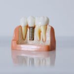 There are several types of dental implants that you have to choose from. Learn more about your options by clicking right here.