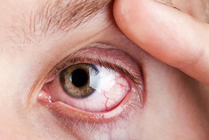 retinopathy caused by diabetes